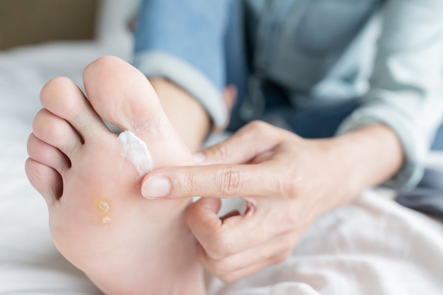 applying cream for athletes foot